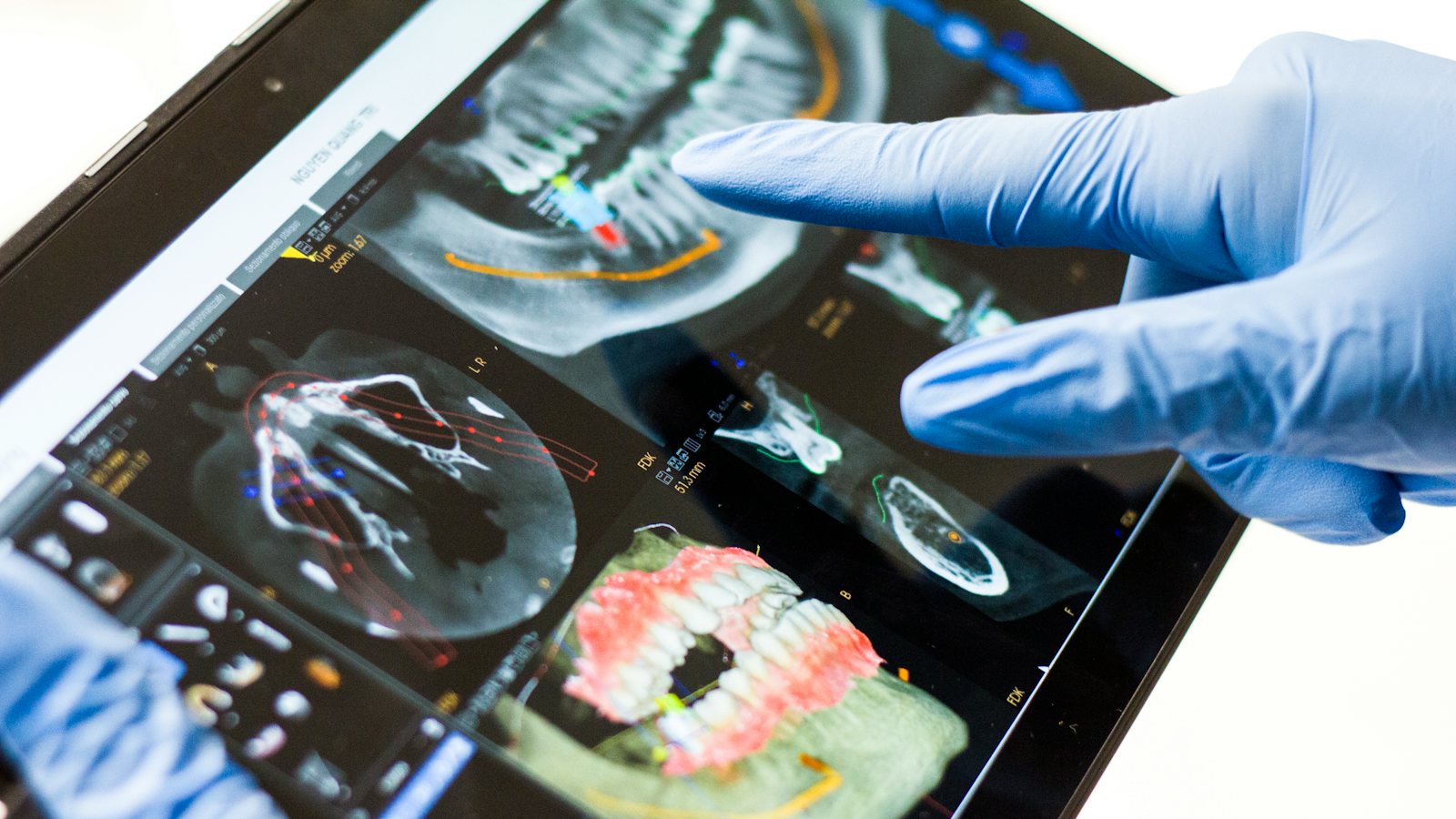 3D-Planung eines Implantats auf einem Tablet